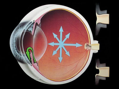 Глаукома на глазу